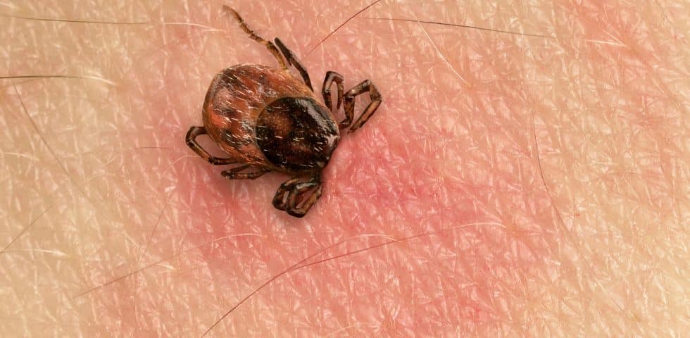 A tick biting someone, giving them Lyme Disease