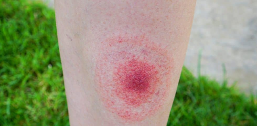 A photo of a bullseye rash on someone's arm, a classic symptom of Lyme Disesase