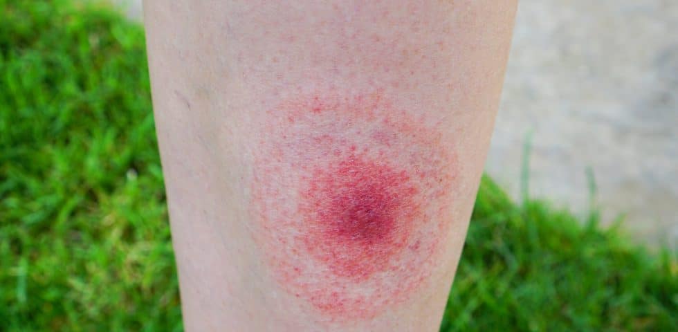 Classic Symptoms of Lyme Disease