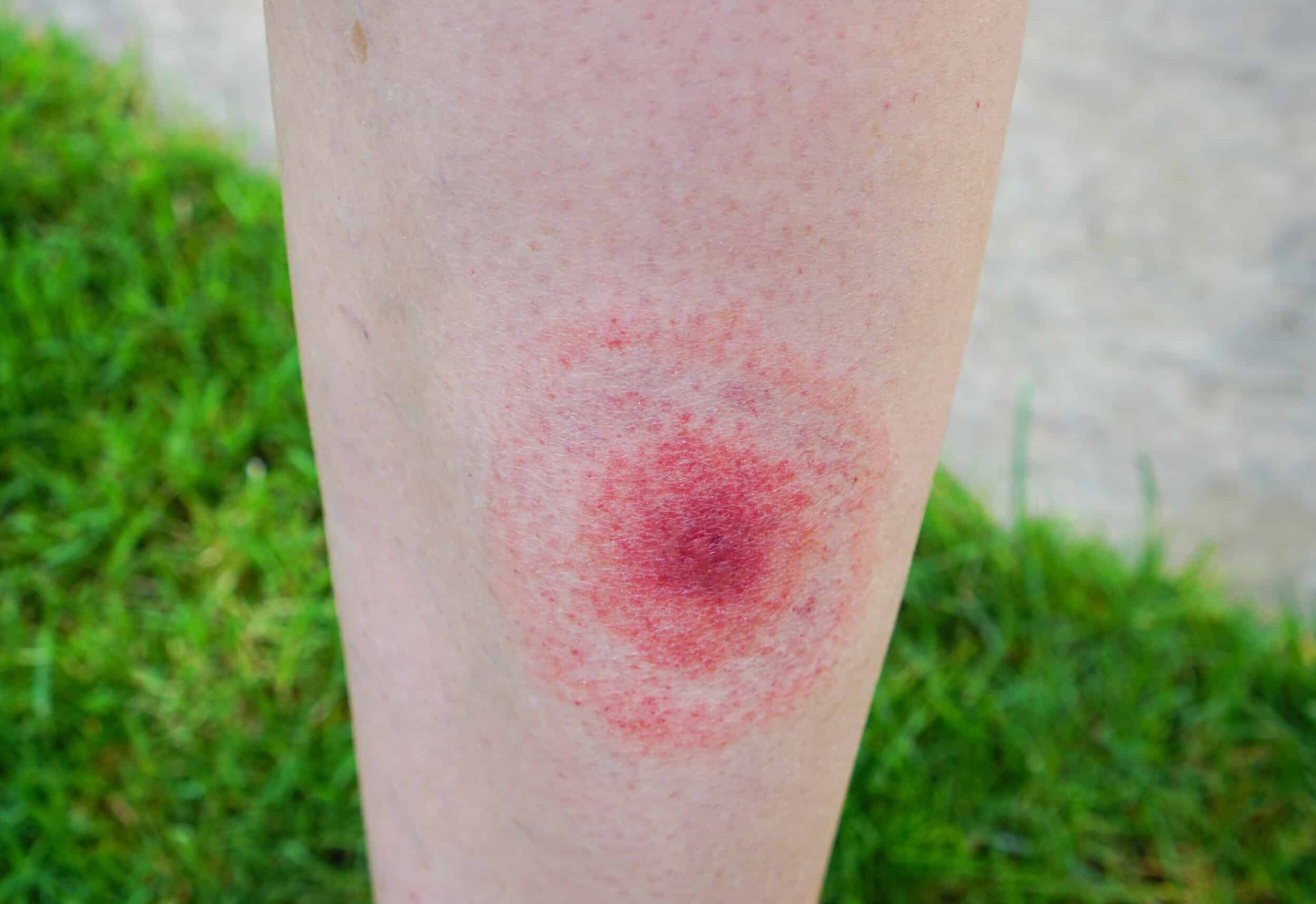 Classic Symptoms of Lyme Disease
