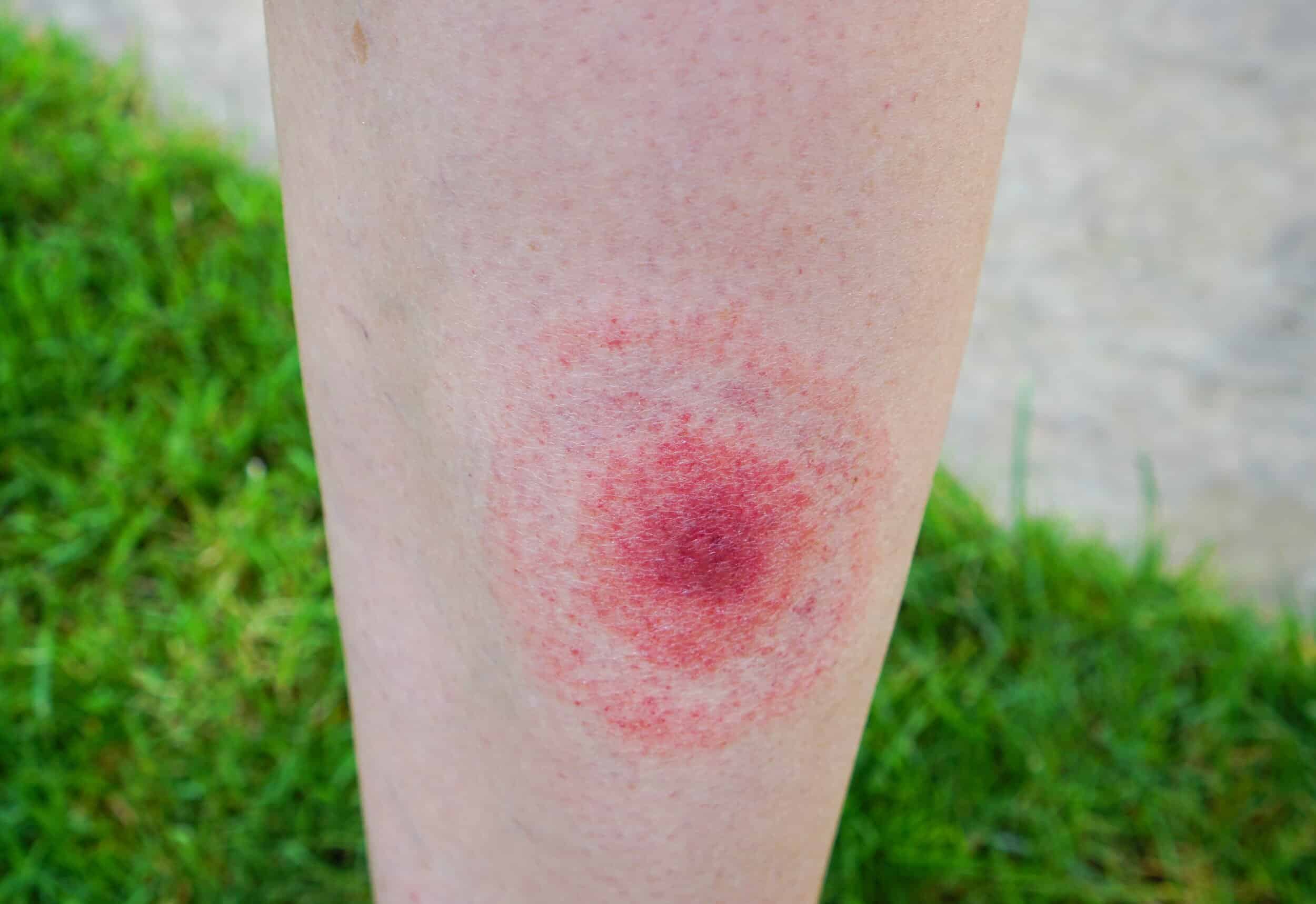 Classic Symptoms Of Lyme Disease