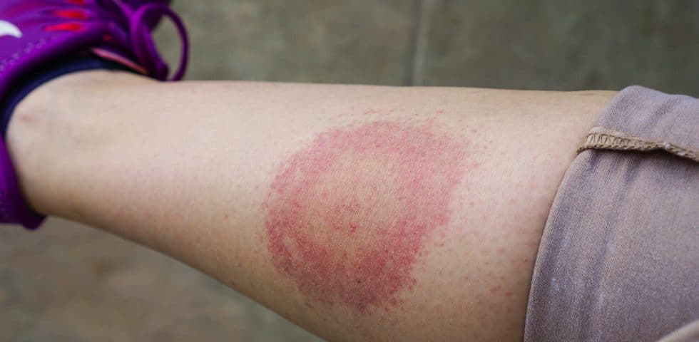 Bullseye rash on person's leg, a common Lyme Disease sympromt